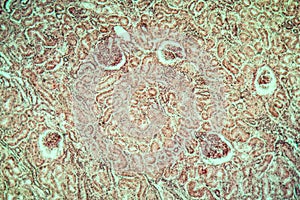 Kidney tuberculosis Diseased tissue