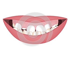 Kids mouth with a too big mandible and high smile line or gummy smile before the orthotropics or orthotropics treatment