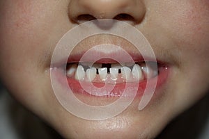 Kids teeths - closeup look