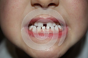 Kids teeths - closeup look