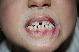 Kids teeths - closeup look photo