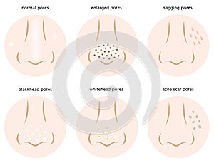 Kinds of skin pores