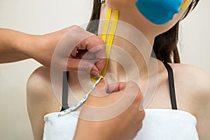 Kinesio taping. The physiotherapist applies kinesiology tape to the patient`s neck. Post-traumatic rehabilitation