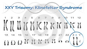 klinefelter syndrome karyotype vector illustration XXY Trisomy photo