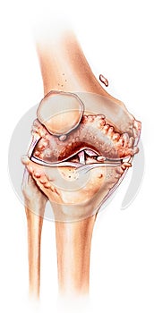 Knee - Advanced Osteoarthritis, Front View