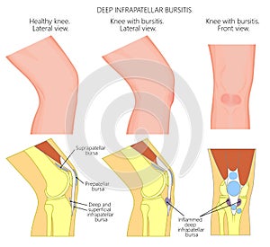 Knee bursitis_Deep infrapatellar bursitis