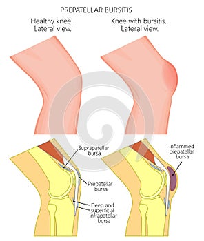 Knee bursitis_Prepatellar bursitis