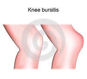 Knee bursitis. Prepatellar bursitis