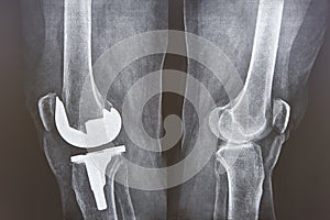 Knee cap replacement xrays. Titanium implant. Osteoarthritis. Anatomy