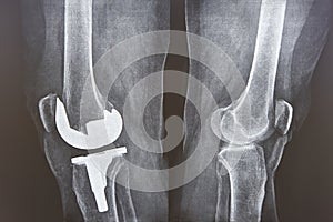 Knee cap replacement xrays. Titanium implant. Osteoarthritis. Anatomy photo