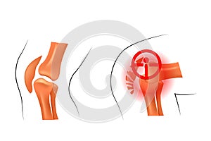 Knee, dislocation, fracture. traumatology and orthopedics photo