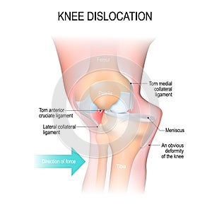 Knee dislocation. photo