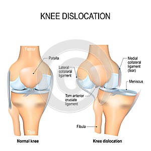 Knee dislocation and normal.