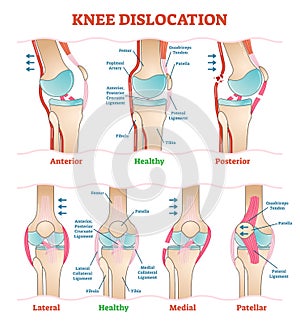 Rodilla médico ilustraciones diagramas. anatómico rodilla lesión tipos sistema 