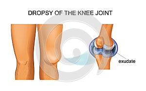 knee hydrarthrosis, articular dropsy