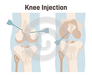 Knee injection. Joint treatment, injection with corticosteroid, or hyaluronic