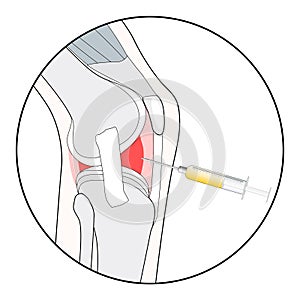 Knee injection. prp biotechnology, Hyaluronic acid injection, or medical procedure for osteoarthritis treatment