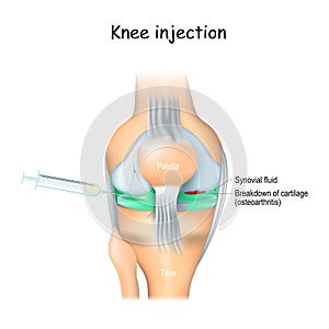 Knee Injections photo
