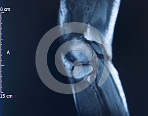 Knee injury mri mcl tear