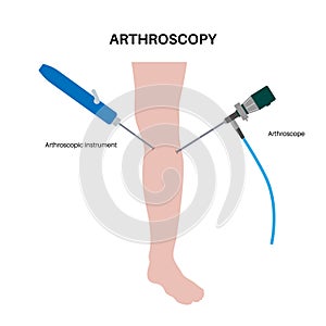 Knee joint arthroscopy