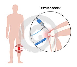 Knee joint arthroscopy photo