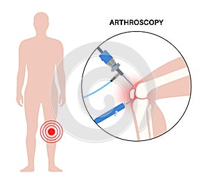 Knee joint arthroscopy photo