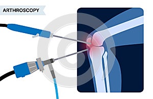 Knee joint arthroscopy photo