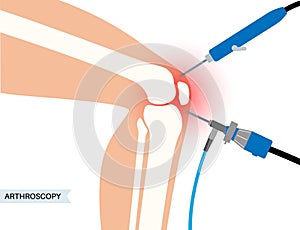 Knee joint arthroscopy photo