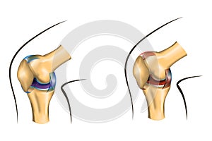 The knee joint of healthy and damaged