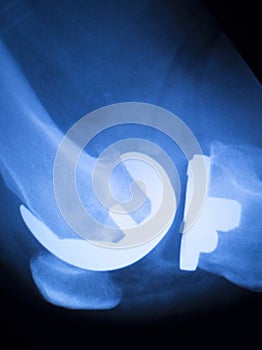 Knee joint implant x-ray test scan