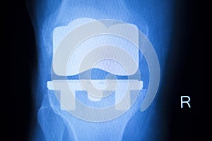 Knee joint implant x-ray test scan