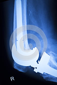 Knee joint implant x-ray test scan