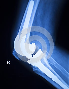 Knee joint implant x-ray test scan