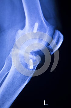 Knee joint implant xray