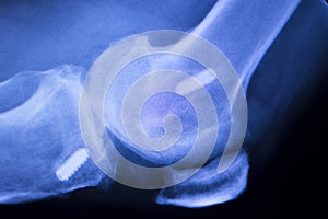 Knee joint implant xray