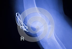 Knee joint implant xray