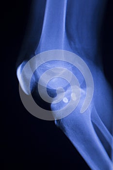 Knee joint implant xray