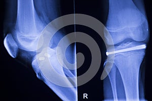 Knee joint implant xray