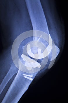 Knee joint implant xray