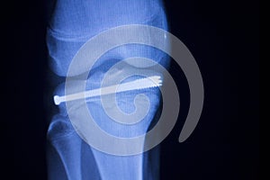 Knee joint implant xray