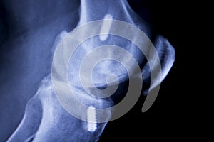 Knee joint implant xray