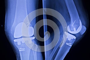 Knee joint implant xray