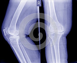 Knee joint inflammation.Osteoarthritis OA knee . film x-ray