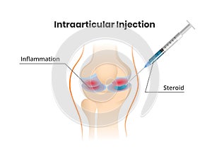 Knee joint injection. Injection of the corticosteroids scientific illustration photo