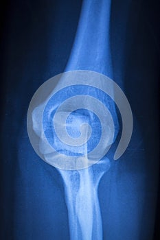 Knee joint meniscus x-ray test scan