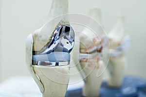 Knee joint model or mock-up with knee replacement prosthesis in osteoarthritis