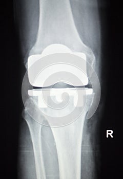 Knee joint orthopedics implant xray