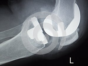 Knee joint orthopedics implant xray