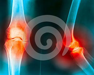 Knee joint pain photo