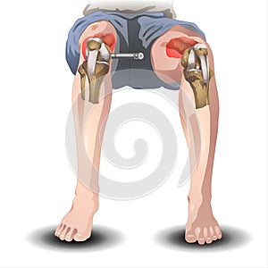 Knee Joint Pain Silhouette Icon Ache of Knee, Skeleton, Arthritis, - illustration on white background